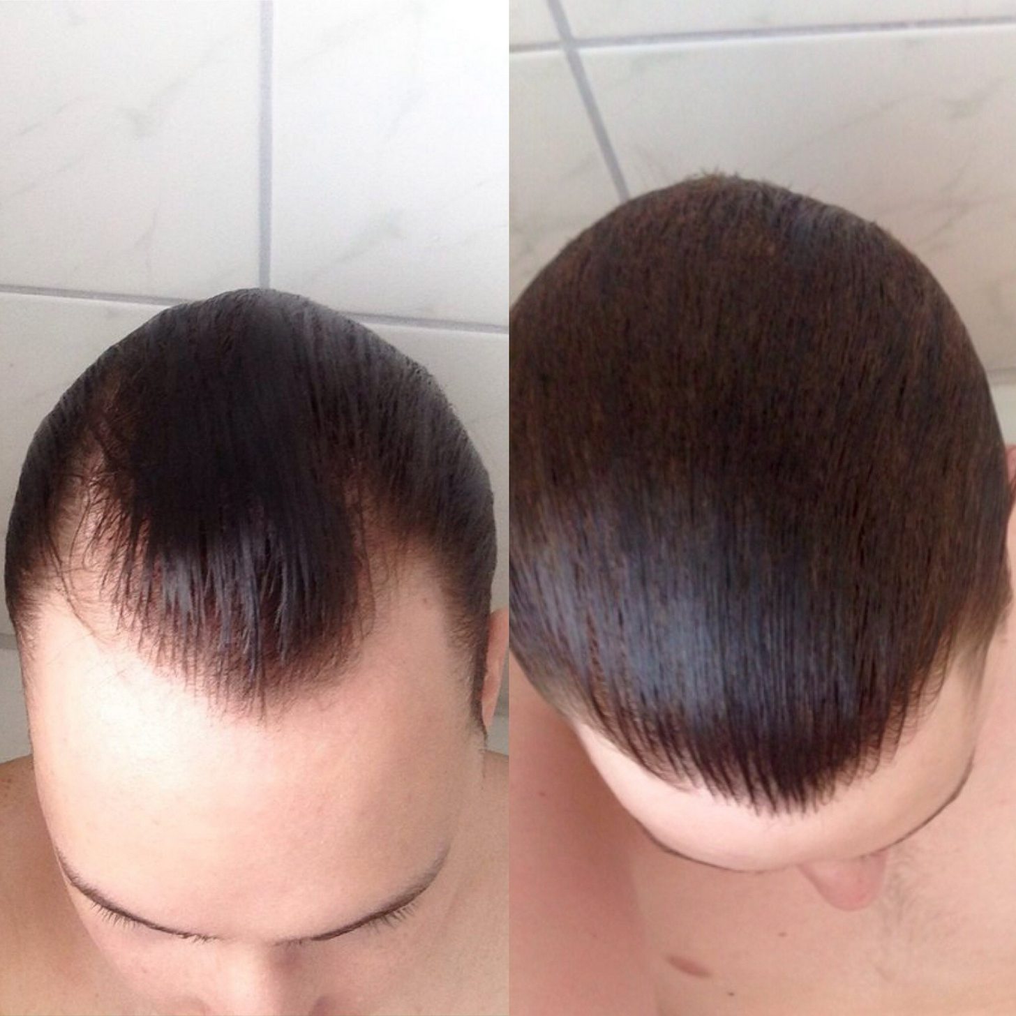 Finasteride ohne rezept
