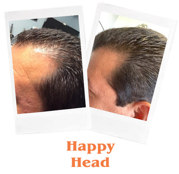 Finasteride and minoxidil online Finasteride and minoxidil online
