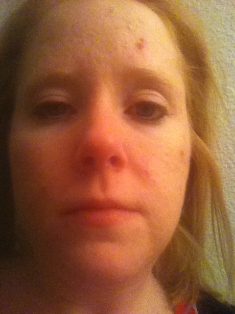 Accutane 5mg Accutane 5mg
