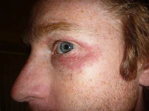 generische isotretinoin Generische Isotretinoin