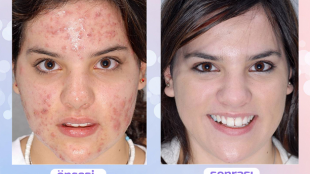 Roaccutane in deutschland Roaccutane in deutschland