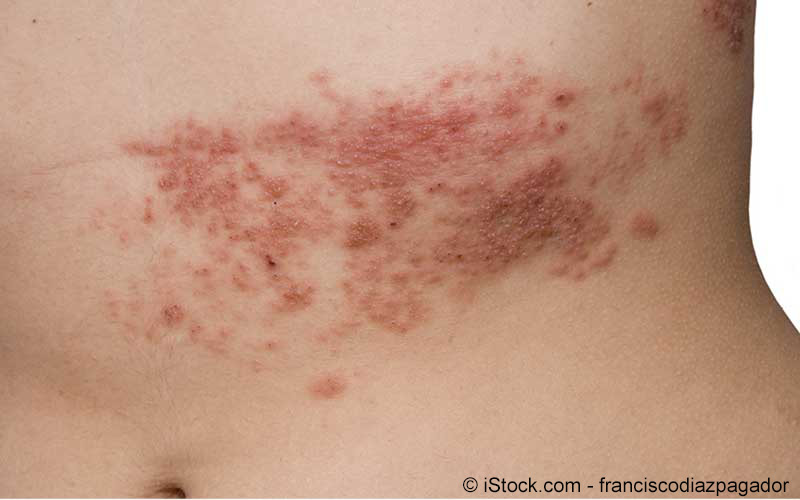 Zovirax tabletten gurtelrose Zovirax tabletten gurtelrose