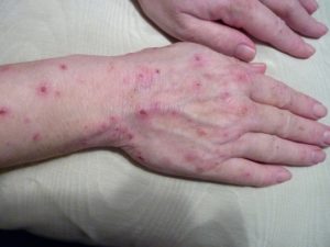 Prednisolon pille Prednisolon Pille