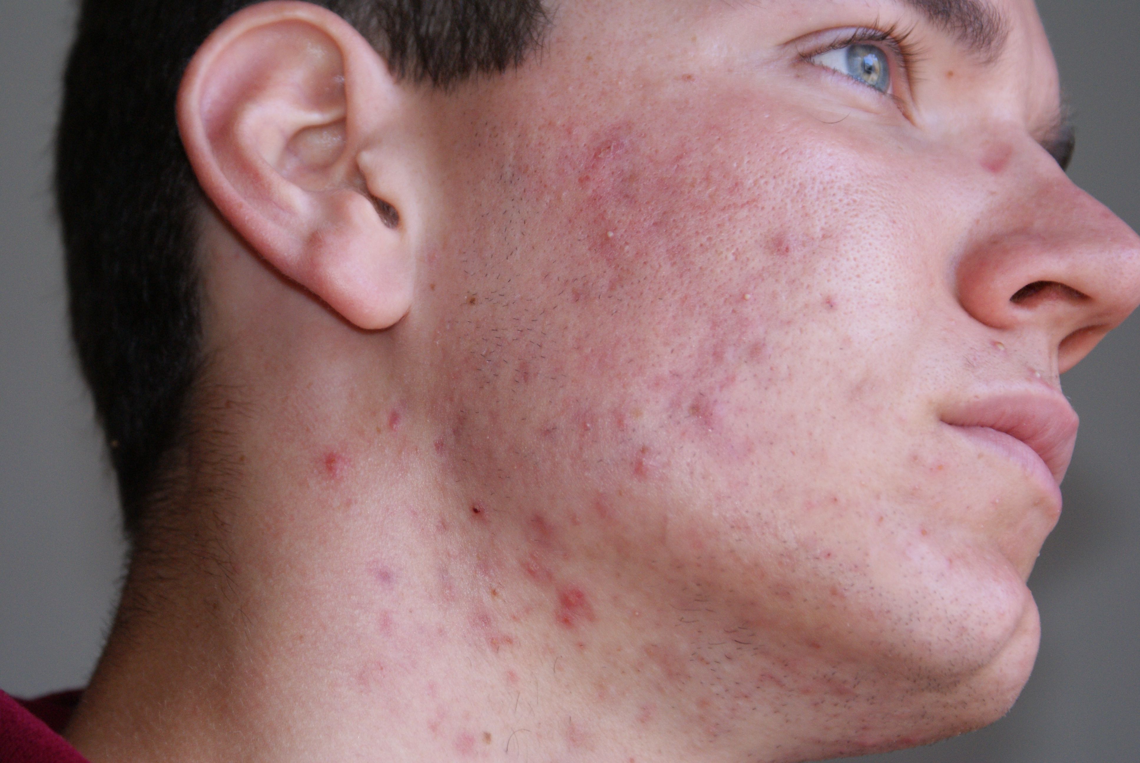 roaccutane tablette Roaccutane tablette