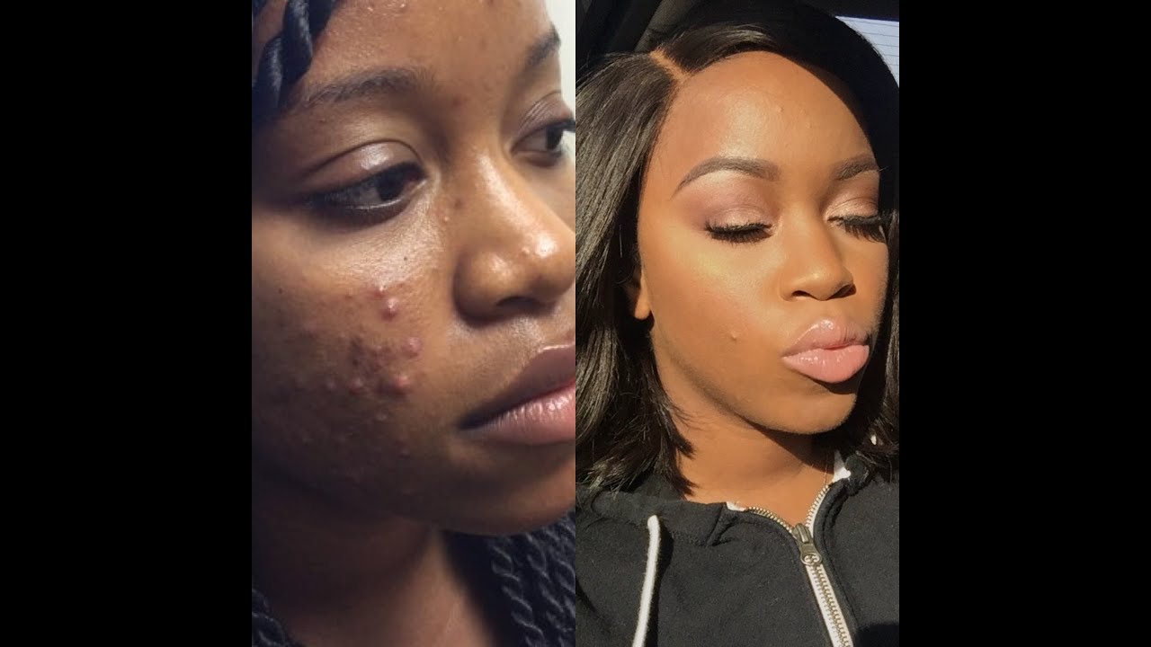 Accutane 10mg online accutane 10mg online