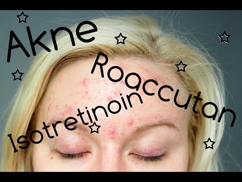 Roaccutan wie zu kaufen Roaccutan wie zu kaufen