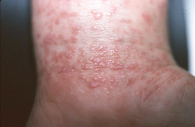 generisches accutane Generisches accutane