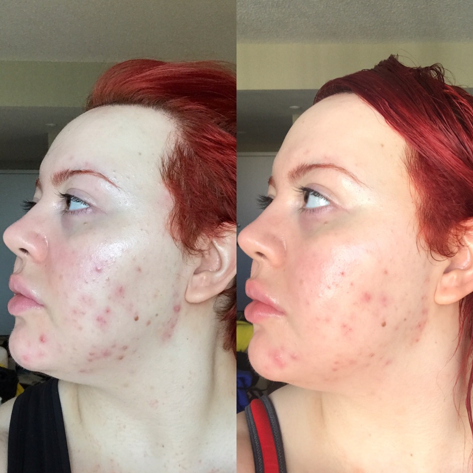 Isotretinoin in deutschland Isotretinoin In Deutschland