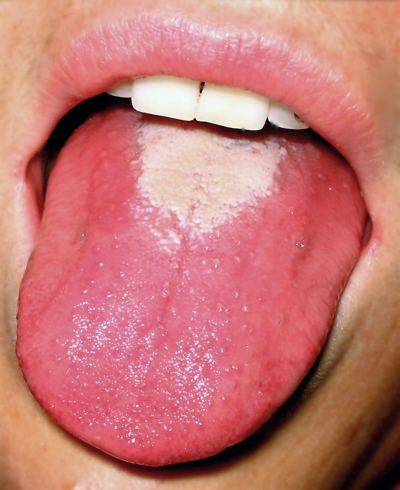 Amoxicillin Für Angina amoxicillin für angina