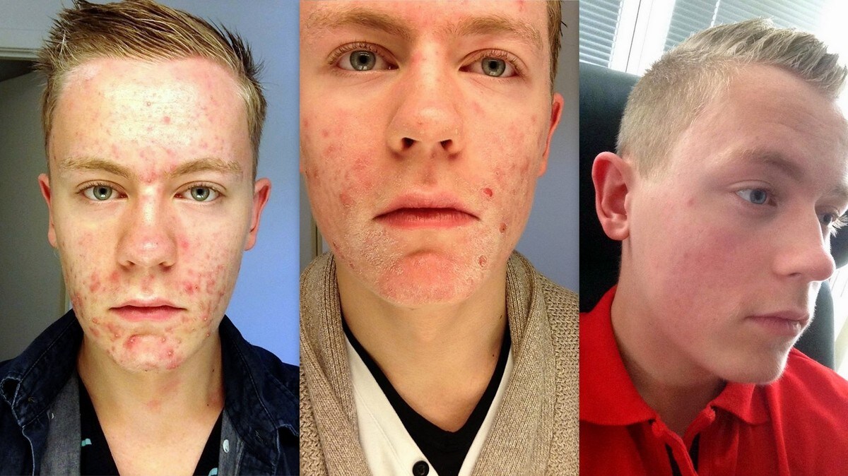 Roaccutane pille Roaccutane Pille