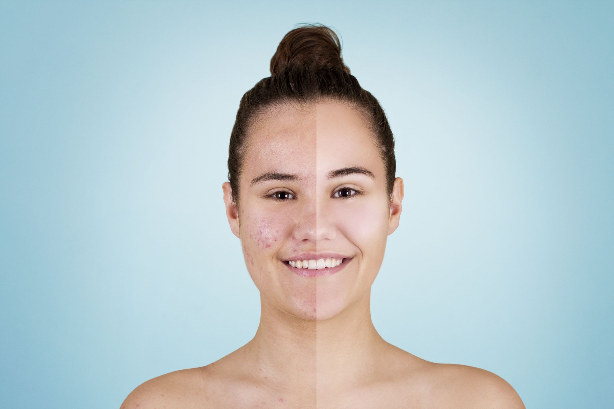 Accutane tablette Accutane tablette