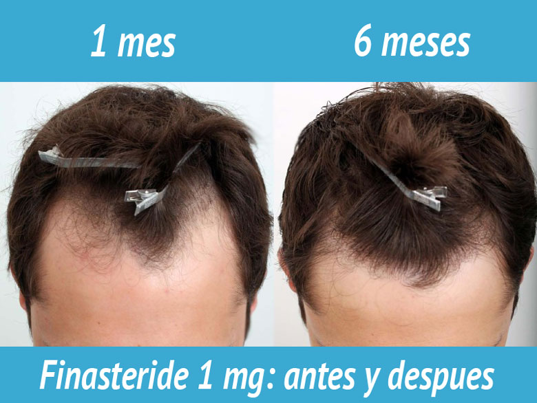 finasteride apotheke online