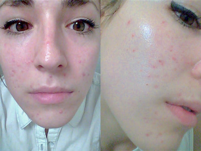 Roaccutane deutschland Roaccutane deutschland