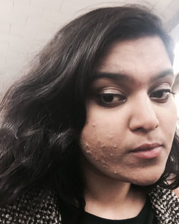 Kosten für accutane kosten für accutane