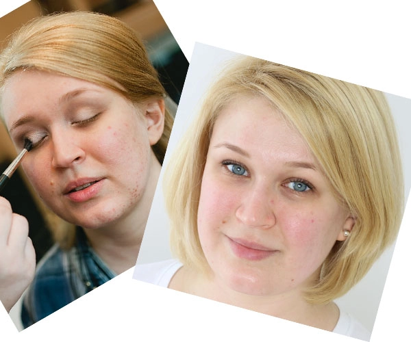 accutane ohne pille Accutane Ohne Pille