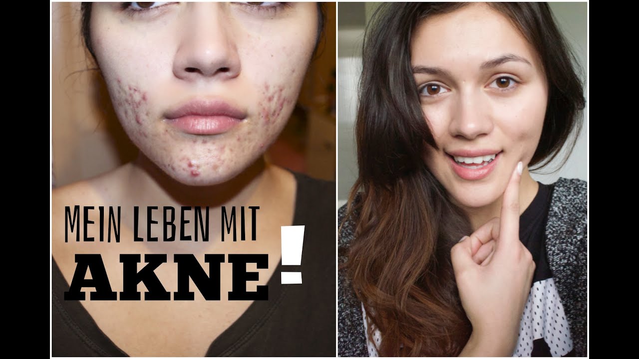 Aknenormin nur mit pille Aknenormin nur mit pille
