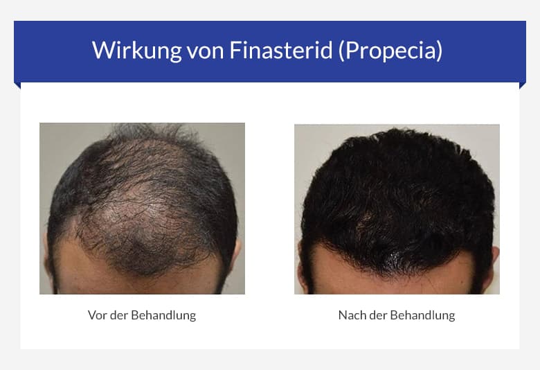 Finasterid haarausfall kosten
