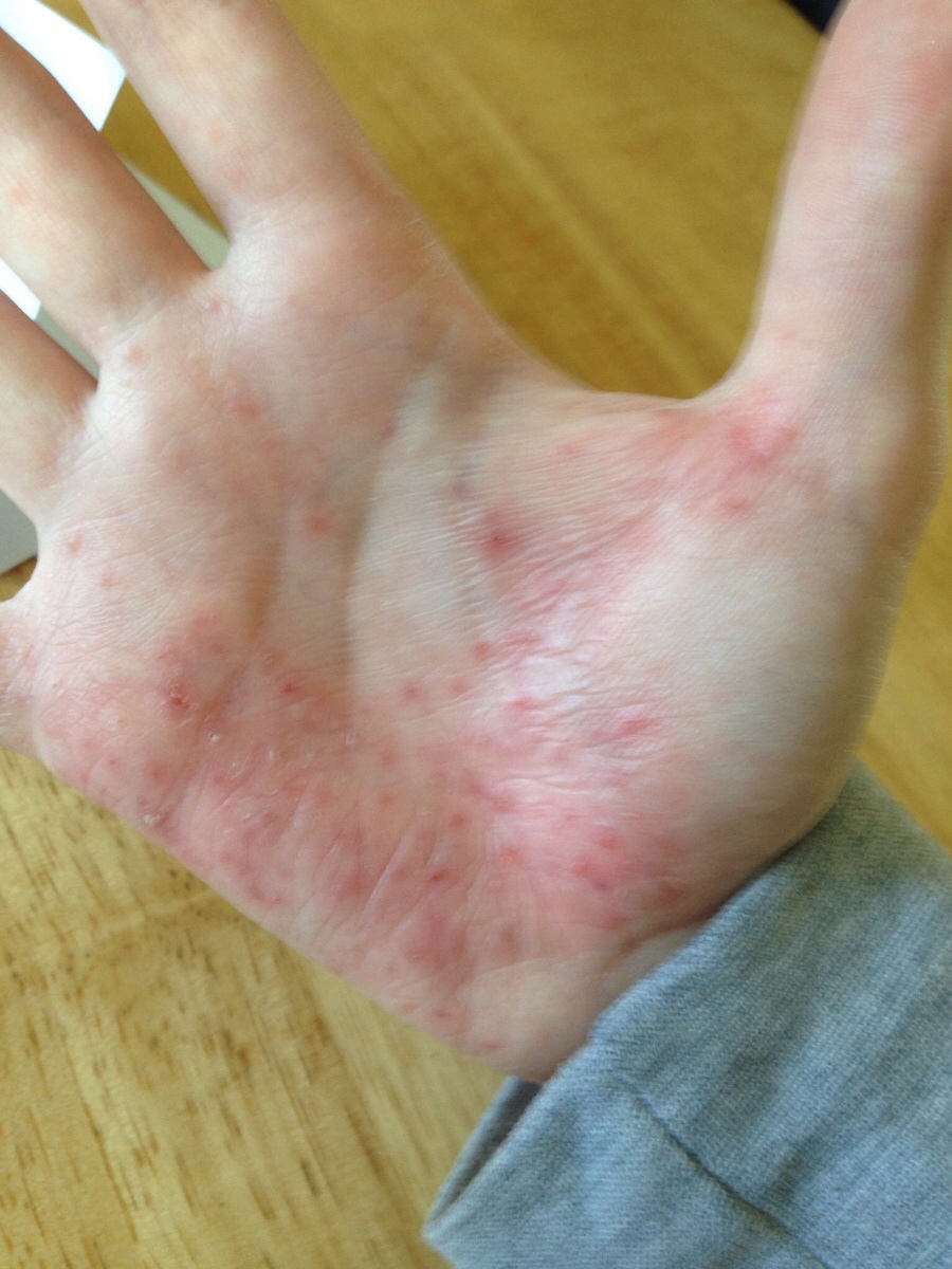 aciclovir i.v. preis Aciclovir i.v. preis