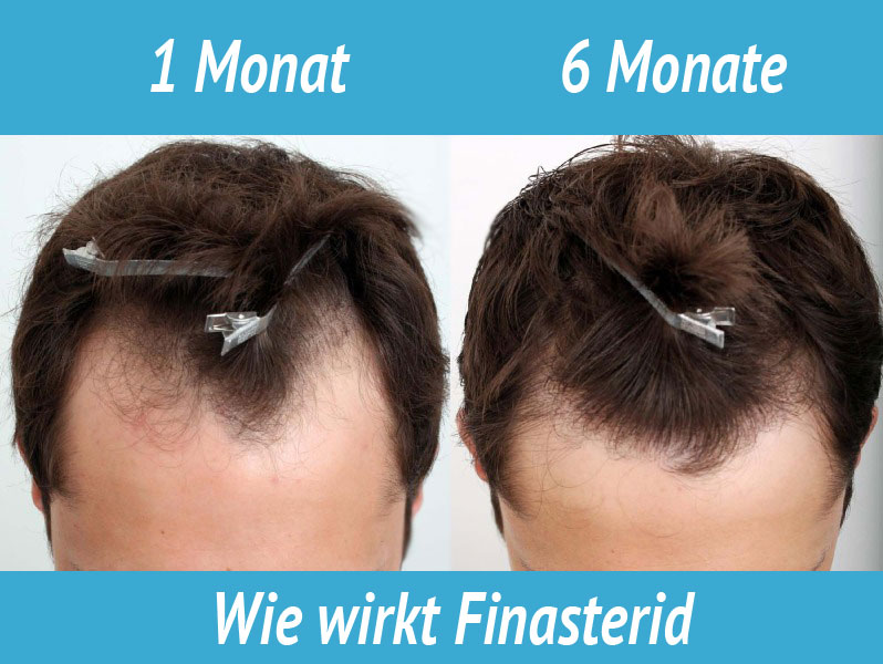 wie finasteride kaufen