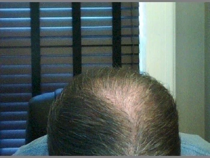 topical finasteride kaufen Topical finasteride kaufen