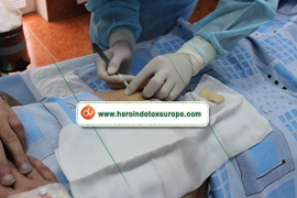 Disulfiram implantat kosten