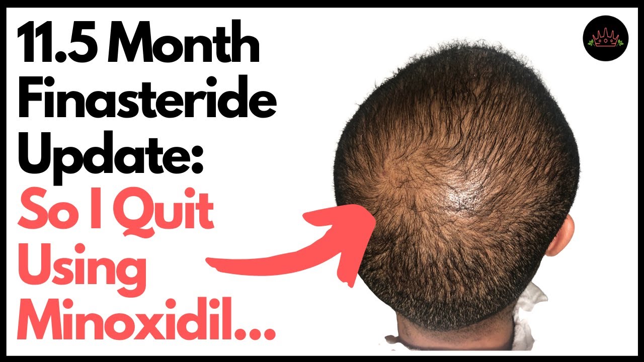 finasteride am billigsten finasteride am billigsten