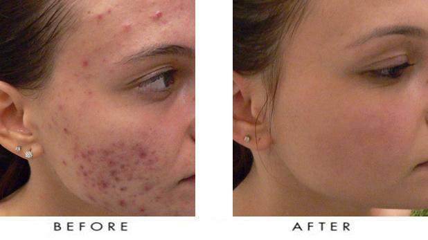 Accutane Tablette