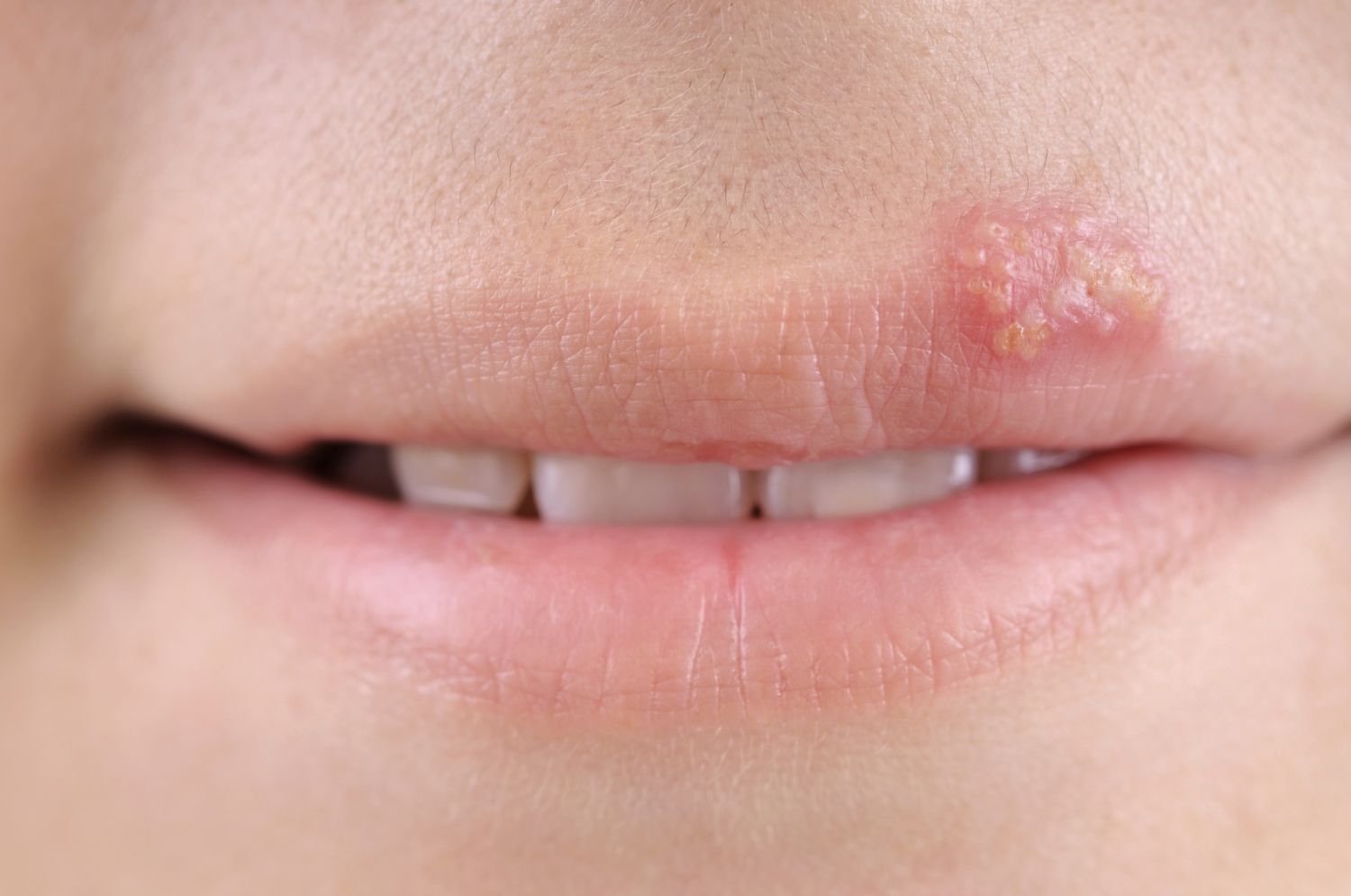 Aciclovir Creme Genitalherpes Rezeptfrei Aciclovir Creme Genitalherpes Rezeptfrei