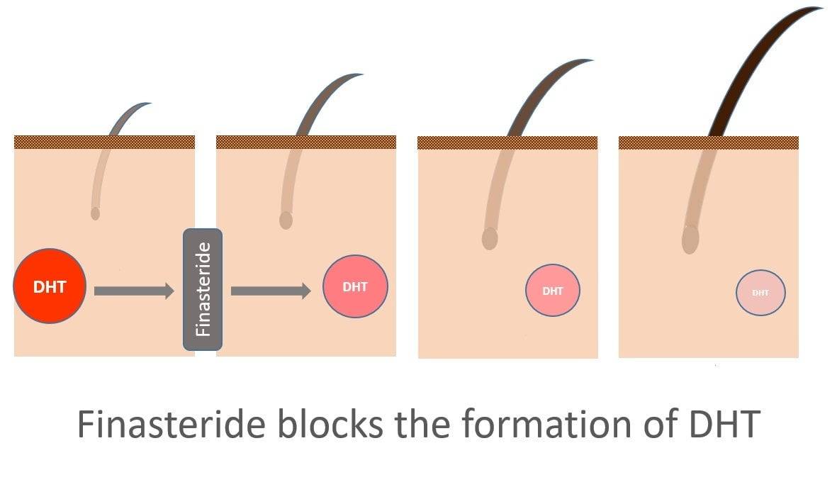 Finasteride am billigsten