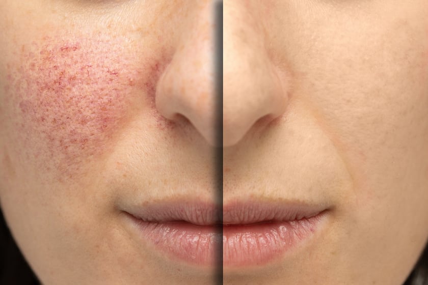 ivermectin creme kaufen ohne rezept