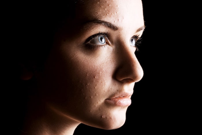 Accutane am billigsten Accutane am billigsten