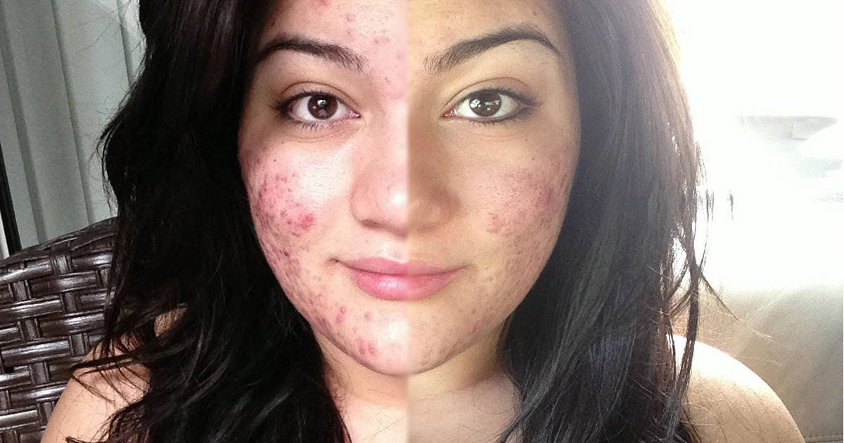 accutane ohne rezept accutane ohne rezept