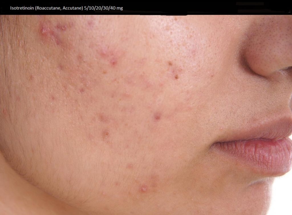 Accutane Wie Zu Kaufen Accutane wie zu kaufen