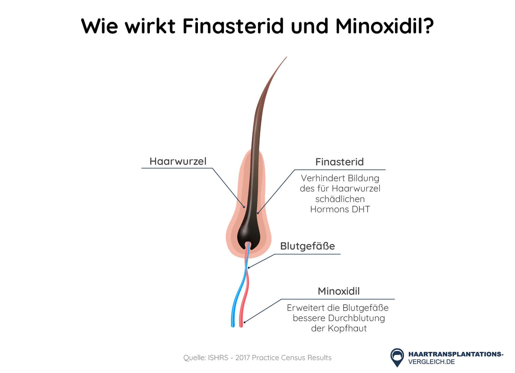 finasterid 1mg deutschland