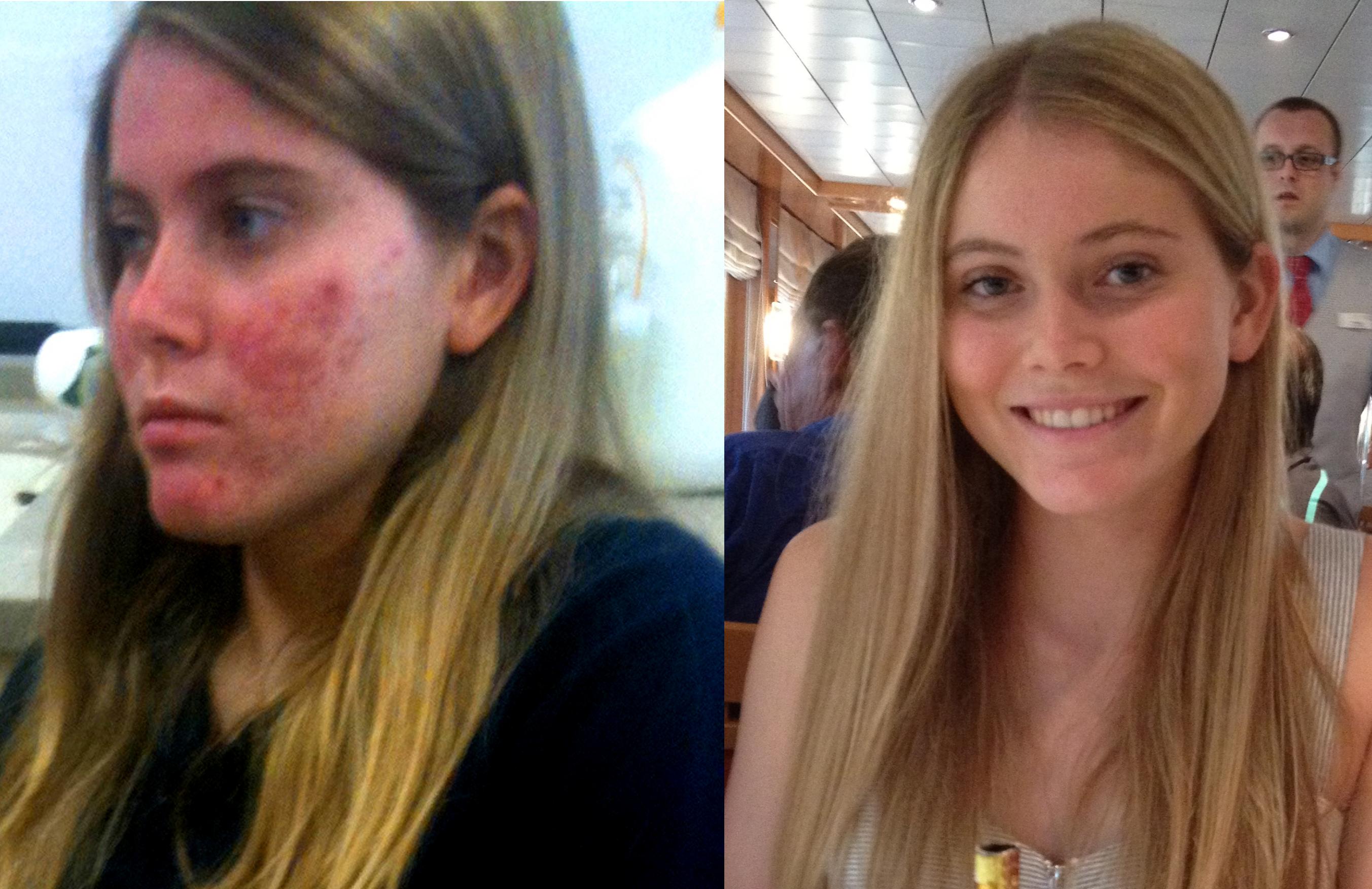 roaccutane kosten roaccutane kosten
