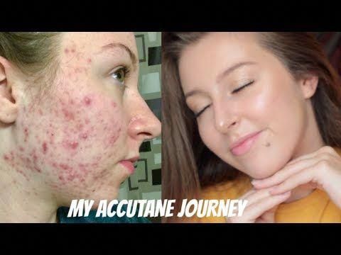 Roaccutane generikum Roaccutane Generikum