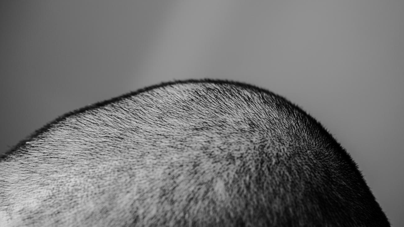 Dermapharm Finasterid Finapil Kaufen