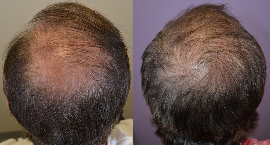 Finasteride And Minoxidil Online
