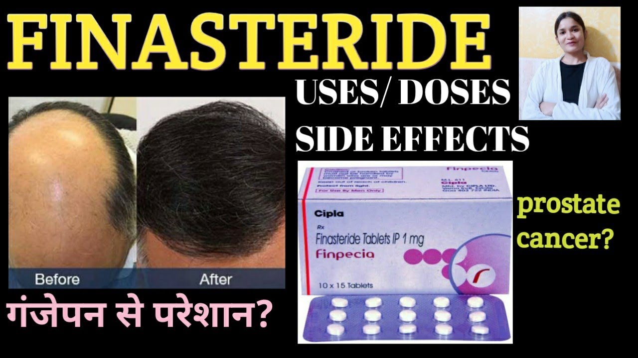 Finasteride Finpecia 1mg