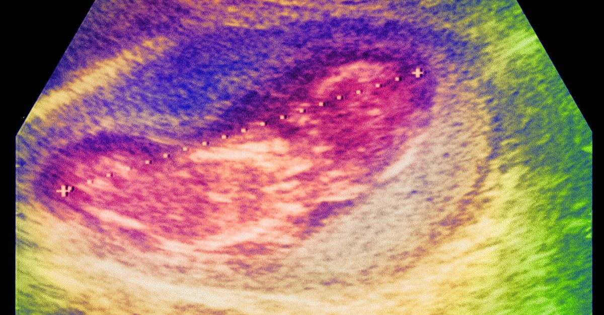 misoprostol kosten