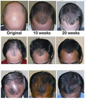 preis von finasteride