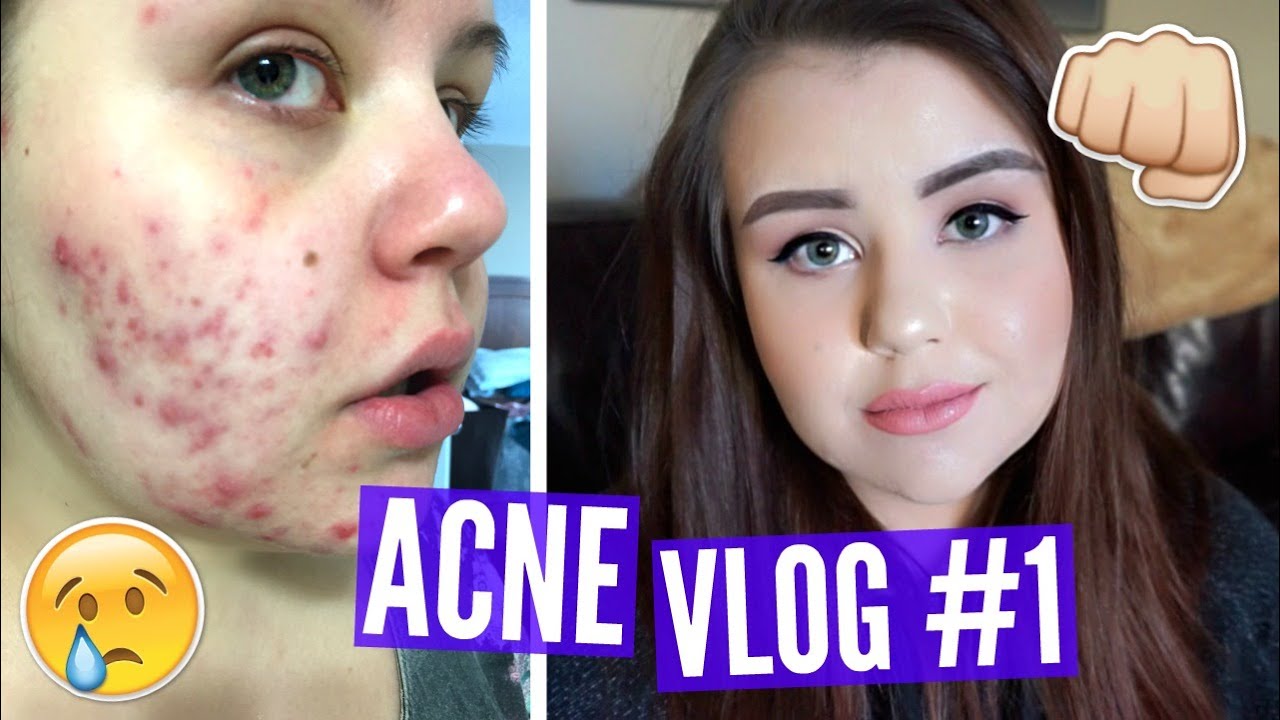 Roaccutane apotheke online roaccutane apotheke online