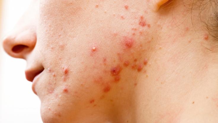 roaccutane tabletten roaccutane tabletten